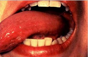 Medicamento para el papiloma en la boca - Carte de Leacuri Si Retete Naturiste